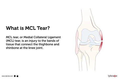 standing twist test for mcl tear|mcl tear treatment.